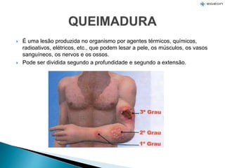  É uma lesão produzida no organismo por agentes térmicos, químicos,
radioativos, elétricos, etc., que podem lesar a pele, os músculos, os vasos
sanguíneos, os nervos e os ossos.
 Pode ser dividida segundo a profundidade e segundo a extensão.
 