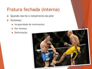 Fratura fechada (interna)
 Quando não há o rompimento da pele
 Sintomas:
 Incapacidade de movimentar.
 Dor intensa;
 Deformação;
 