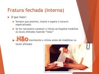 Fratura fechada (interna)
 O que fazer:
 Sempre que possível, chame e espere o socorro
especializado;
 Se for necessário conduzir a vítima ao hospital imobilize
os locais afetados fazendo “talas”
movimente a vítima antes de imobilizar os
locais afetados
 