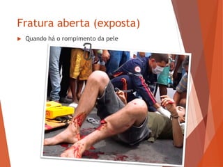 Fratura aberta (exposta)
 Quando há o rompimento da pele
 