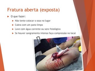 Fratura aberta (exposta)
 O que fazer:
 Não tente colocar o osso no lugar
 Cubra com um pano limpo
 Lave com água corrente ou soro fisiológico
 Se houver sangramento intenso faça compressão no local
 