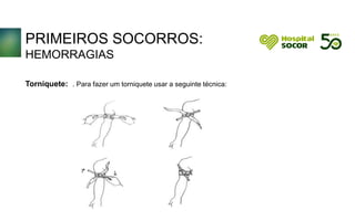 PRIMEIROS SOCORROS:
HEMORRAGIAS
Torniquete: . Para fazer um torniquete usar a seguinte técnica:
 