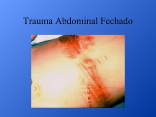 Trauma Abdominal Fechado

 