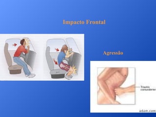 Impacto Frontal

Agressão

 
