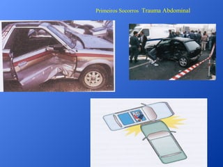 Primeiros Socorros Trauma Abdominal

 