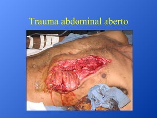 Trauma abdominal aberto

 