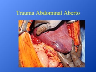 Trauma Abdominal Aberto

 