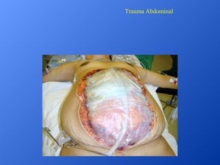 Trauma Abdominal

 