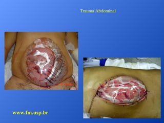 Trauma Abdominal

www.fm.usp.br

 