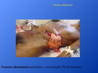 Trauma Abdominal

Trauma abdominal penetrante - evisceração PS da Famema

 