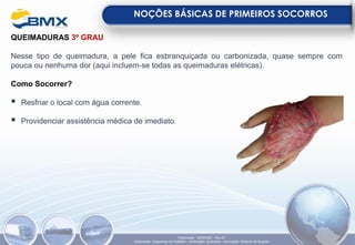 QUEIMADURAS 3º GRAU
Nesse tipo de queimadura, a pele fica esbranquiçada ou carbonizada, quase sempre com
pouca ou nenhuma dor (aqui incluem-se todas as queimaduras elétricas).
Como Socorrer?
▪ Resfriar o local com água corrente.
▪ Providenciar assistência médica de imediato.
NOÇÕES BÁSICAS DE PRIMEIROS SOCORROS
Elaboração: 18/04/2022 - Rev.00
Elaboração: Segurança do Trabalho - Verificação: Qualidade - Aprovação: Diretoria de Suporte
 