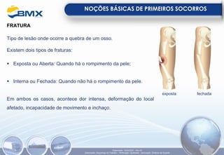 FRATURA
Tipo de lesão onde ocorre a quebra de um osso.
Existem dois tipos de fraturas:
▪ Exposta ou Aberta: Quando há o rompimento da pele;
▪ Interna ou Fechada: Quando não há o rompimento da pele.
Em ambos os casos, acontece dor intensa, deformação do local
afetado, incapacidade de movimento e inchaço.
NOÇÕES BÁSICAS DE PRIMEIROS SOCORROS
exposta fechada
Elaboração: 18/04/2022 - Rev.00
Elaboração: Segurança do Trabalho - Verificação: Qualidade - Aprovação: Diretoria de Suporte
 