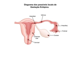 Diagrama dos possíveis locais de
Gestação Ectópica.
 