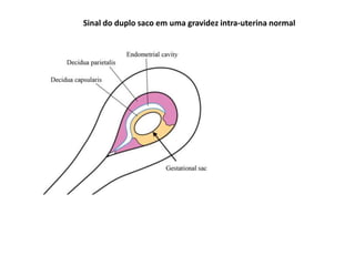 Sinal do duplo saco em uma gravidez intra-uterina normal
 