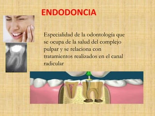 ENDODONCIA 
Especialidad de la odontología que 
se ocupa de la salud del complejo 
pulpar y se relaciona con 
tratamientos realizados en el canal 
radicular 
 