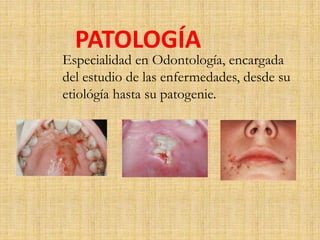 PATOLOGÍA 
Especialidad en Odontología, encargada 
del estudio de las enfermedades, desde su 
etiológía hasta su patogenie. 
 