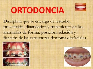 ORTODONCIA 
Disciplina que se encarga del estudio, 
prevención, diagnóstico y tratamiento de las 
anomalías de forma, posición, relación y 
función de las estructuras dentomaxilofaciales. 
 