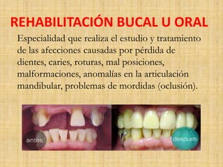 REHABILITACIÓN BUCAL U ORAL 
Especialidad que realiza el estudio y tratamiento 
de las afecciones causadas por pérdida de 
dientes, caries, roturas, mal posiciones, 
malformaciones, anomalías en la articulación 
mandibular, problemas de mordidas (oclusión). 
 