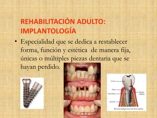 REHABILITACIÓN ADULTO: 
IMPLANTOLOGÍA 
• Especialidad que se dedica a restablecer 
forma, función y estética de manera fija, 
únicas o múltiples piezas dentaria que se 
hayan perdido. 
 