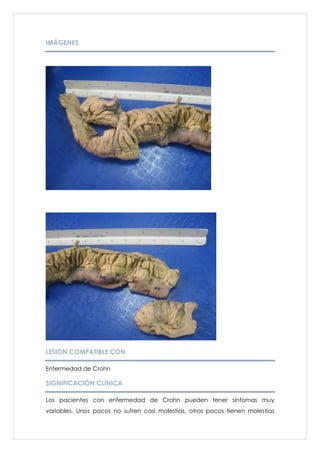 IMÁGENES




LESIÓN COMPATIBLE CON

Enfermedad de Crohn

SIGNIFICACIÓN CLÍNICA

Los pacientes con enfermedad de Crohn pueden tener síntomas muy
variables. Unos pocos no sufren casi molestias, otros pocos tienen molestias
 