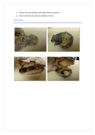 5. Presencia de tabiques de tejido fibroconectivo.
  6. Hay impronta de cálculos biliares mixtos

IMÁGENES
 