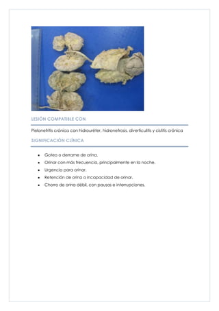 LESIÓN COMPATIBLE CON

Pielonefritis crónica con hidrouréter, hidronefrosis, diverticulitis y cistitis crónica

SIGNIFICACIÓN CLÍNICA


       Goteo o derrame de orina.
       Orinar con más frecuencia, principalmente en la noche.
       Urgencia para orinar.
       Retención de orina o incapacidad de orinar.
       Chorro de orina débil, con pausas e interrupciones.
 