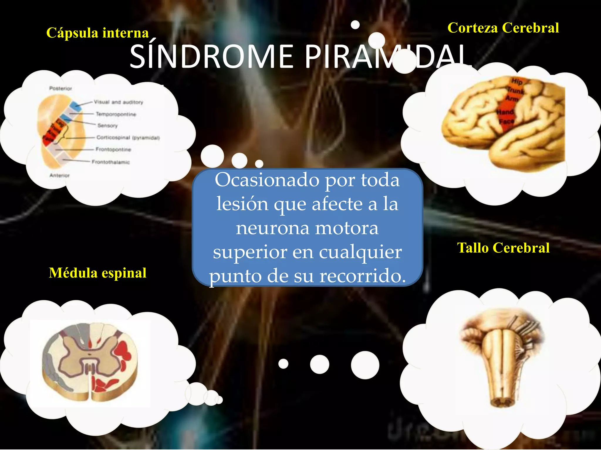 Síndrome de neurona motora superior e inferior