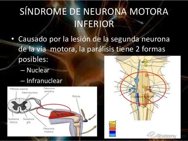 Sindrome De Neurona Motora Superior E Inferior