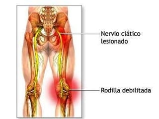 NERVIO CIATICO
MAYOR
 