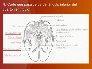 4. Corte que pasa cerca del ángulo inferior del
cuarto ventrículo:
 
