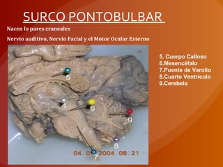 Nacen lo pares craneales
Nervio auditivo, Nervio Facial y el Motor Ocular Externo
5. Cuerpo Calloso
6.Mesencéfalo
7.Puente de Varolio
8.Cuarto Ventrículo
9.Cerebelo
SURCO PONTOBULBAR
 