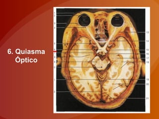 6. Quiasma
Óptico
 