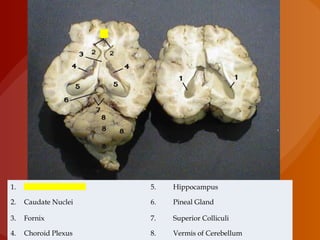 1. Lateral Ventricles 5. Hippocampus
2. Caudate Nuclei 6. Pineal Gland
3. Fornix 7. Superior Colliculi
4. Choroid Plexus 8. Vermis of Cerebellum
 