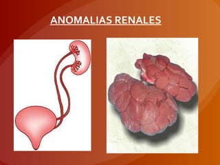 ANOMALIAS RENALES
 