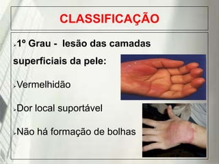 CLASSIFICAÇÃO


1º Grau - lesão das camadas

superficiais da pele:


Vermelhidão



Dor local suportável



Não há formação de bolhas

19/1/2014

 