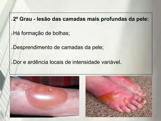 

2º Grau - lesão das camadas mais profundas da pele:



Há formação de bolhas;



Desprendimento de camadas da pele;



Dor e ardência locais de intensidade variável.

19/1/2014

 