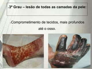 3º Grau – lesão de todas as camadas da pele:



Comprometimento de tecidos, mais profundos



até o osso.

19/1/2014

 