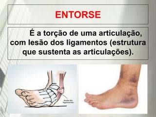 ENTORSE
É a torção de uma articulação,
com lesão dos ligamentos (estrutura
que sustenta as articulações).

19/1/2014

 