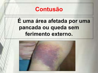 Contusão
É uma área afetada por uma
pancada ou queda sem
ferimento externo.

19/1/2014

 