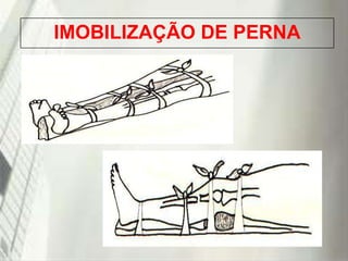 IMOBILIZAÇÃO DE PERNA

19/1/2014

 