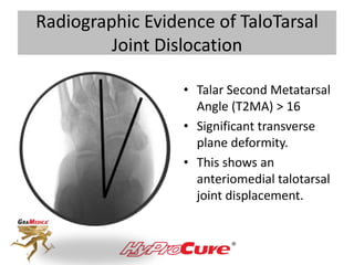 • Talar Second Metatarsal
Angle (T2MA) > 16
• Significant transverse
plane deformity.
• This shows an
anteriomedial talota...