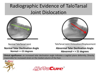 Radiographic Evidence of TaloTarsal
Joint Dislocation
Normal TaloTarsal Joint TaloTarsal Joint Dislocation/Displacement
No...