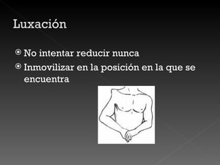 No intentar reducir nunca Inmovilizar en la posición en la que se encuentra 