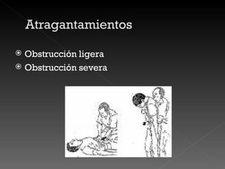 Obstrucción ligera Obstrucción severa 
