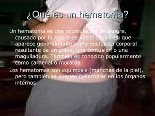¿Qué es un hematoma? Un hematoma es una acumulación de sangre, causado por la rotura de vasos capilares, que aparece generalmente como respuesta corporal resultante de un golpe, una contusión o una magulladura. También es conocido popularmente como cardenal o moratón  Los hematomas son  equimosis  (manchas de la piel), pero también se pueden desarrollar en los órganos internos  