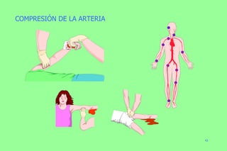 COMPRESIÓN DE LA ARTERIA 