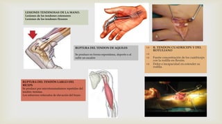 LESIONES TENDINOSAS DE LA MANO.
Lesiones de los tendones extensores
Lesiones de los tendones flexores

RUPTURA DEL TENDON DE AQUILES



Se produce en forma espontánea, deporte o al
subir un escalón





RUPTURA DEL TENDÓN LARGO DEL
BÍCEPS
Se produce por microtraumatismos repetidos del
tendón: tenistas.
Los esfuerzos reiterados de elevación del brazo

R. TENDON CUADRICEPS Y DEL
ROTULIANO
Fuerte concentración de los cuádriceps
con la rodilla en flexión.
Dolor e incapacidad en extender su
rodilla.

 