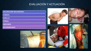 EVALUACIÓN Y ACTUACIÓN
VALORACIÓN SECUNDARIA:
CABEZA
CUELLO
TÓRAX:
ABDOMEN

EXTREMIDADES

 