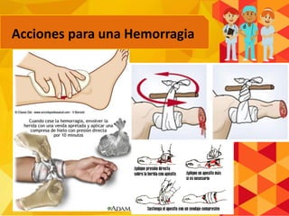 Acciones para una Hemorragia
 