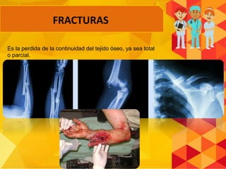 Es la perdida de la continuidad del tejido óseo, ya sea total
o parcial.
FRACTURAS
 
